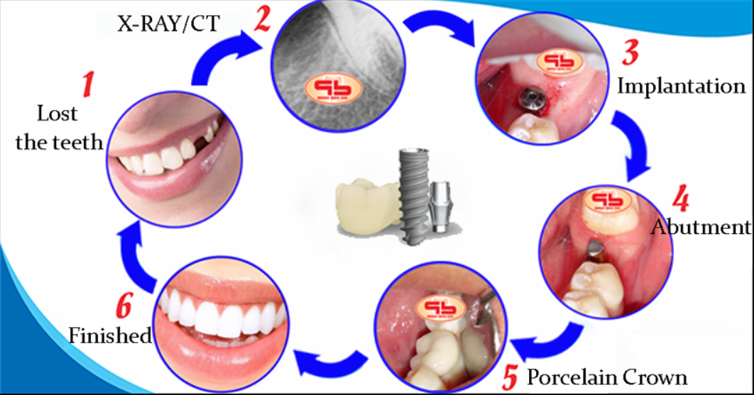 Stages of Dental Implant Placement: From Consultation to Result